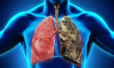 cancer pulmonar 590x354
