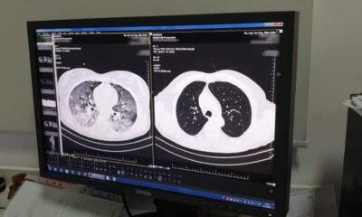 24 martie: ziua mondială a tuberculozei. marchează o descoperire importantă