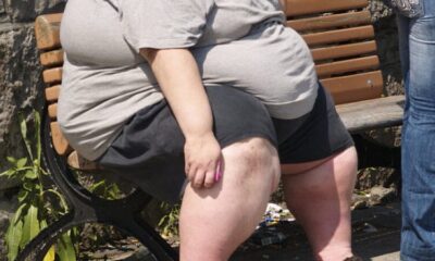 obezitatea, recunoscută oficial ca boală cronică de oms. medicamentele ar